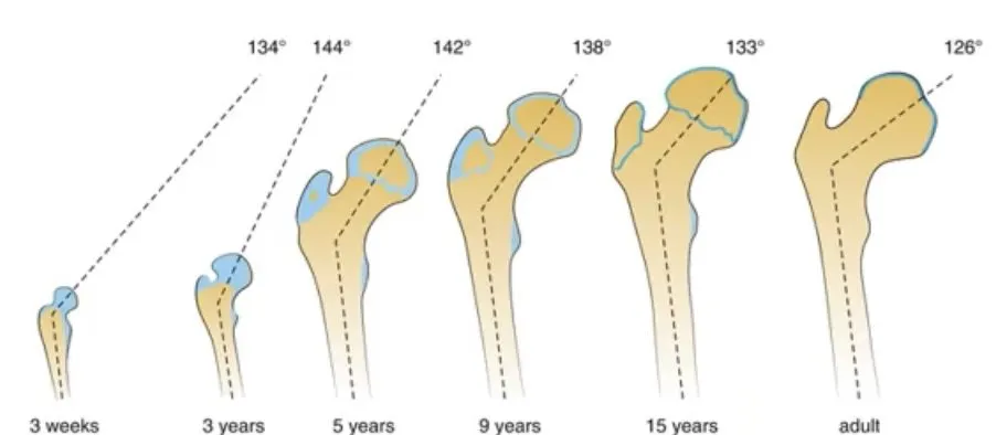 Slide 3 — neck–shaft angle by age