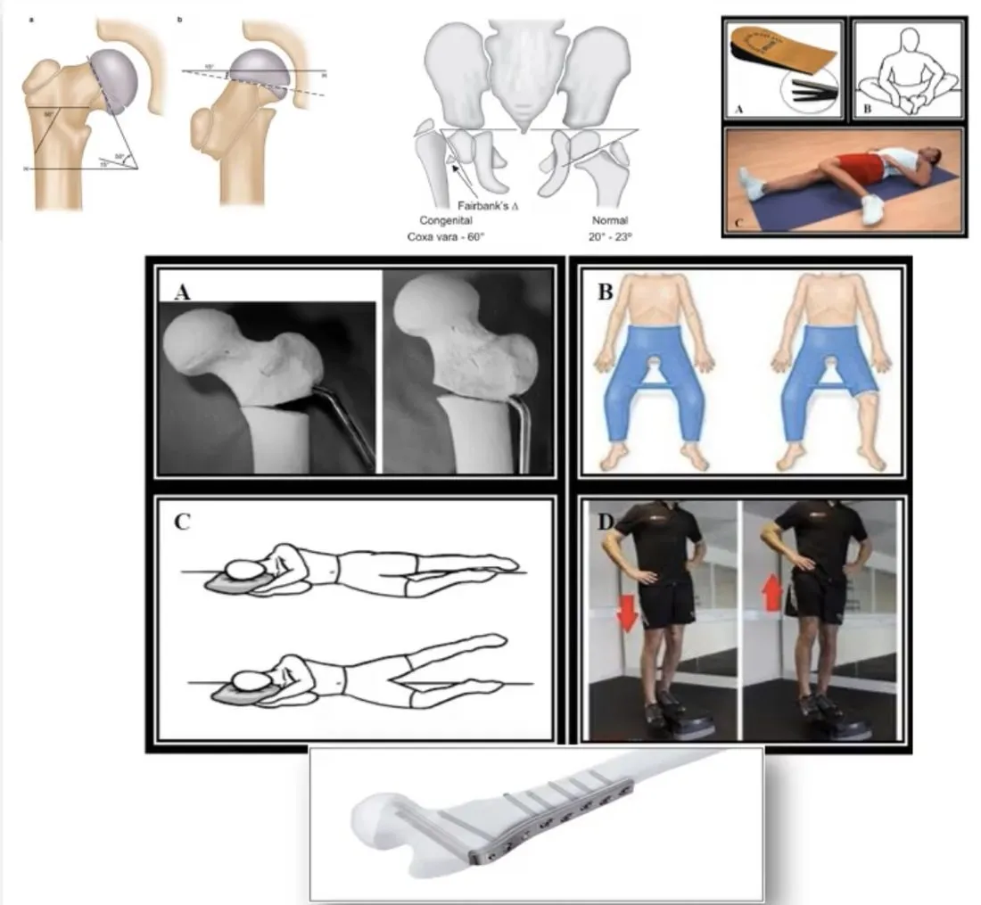 Slide 5 — heel lift, adductor stretch, side-lying abduction, hip hiking, osteotomy and blade plate