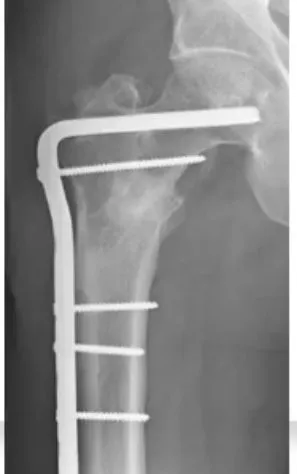 Slide 6 — osteotomy fixed with a bifurcated blade plate