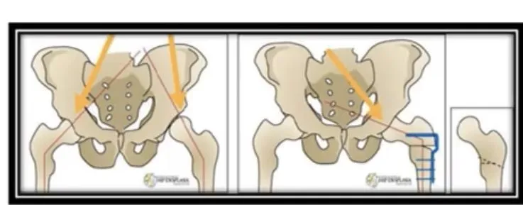 Slide 8 — femoral osteotomy to correct coxa valga