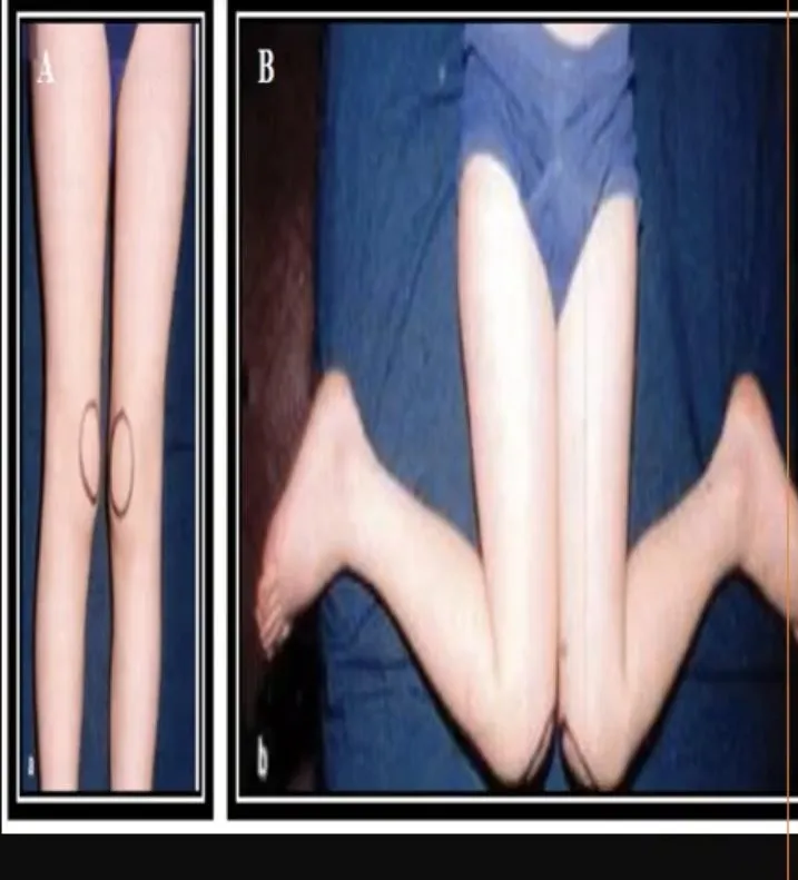 Slide 10 — kissing patellae (A) and W-sitting (B)