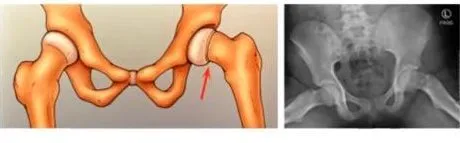 Slide 12 — femoral retroversion