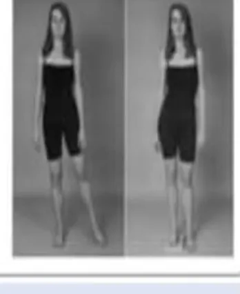 Slide 17 — fixed abduction deformity