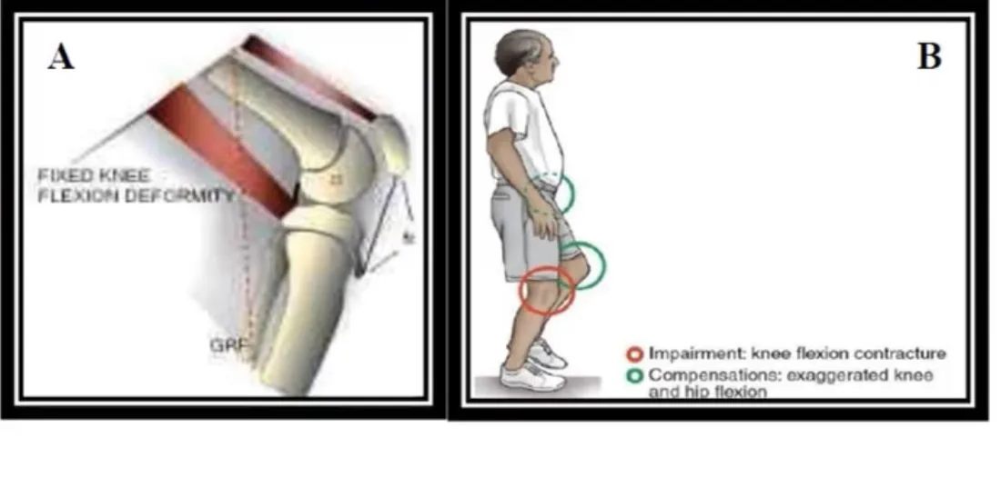 Slide 20 — fixed knee flexion deformity