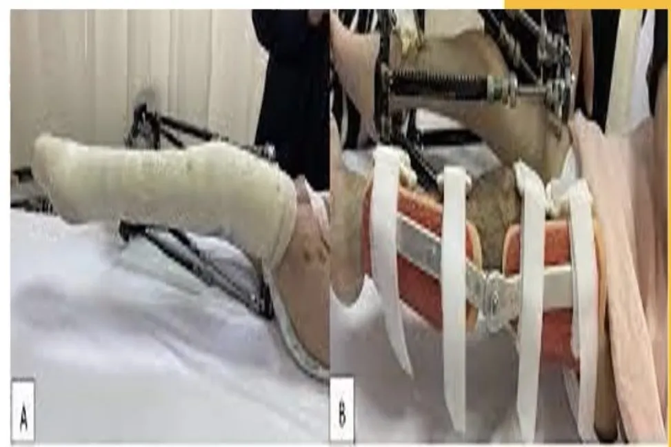 Slide 23 — casting and splints