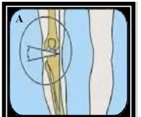 Slide 24 — knee lateral to the mechanical axis