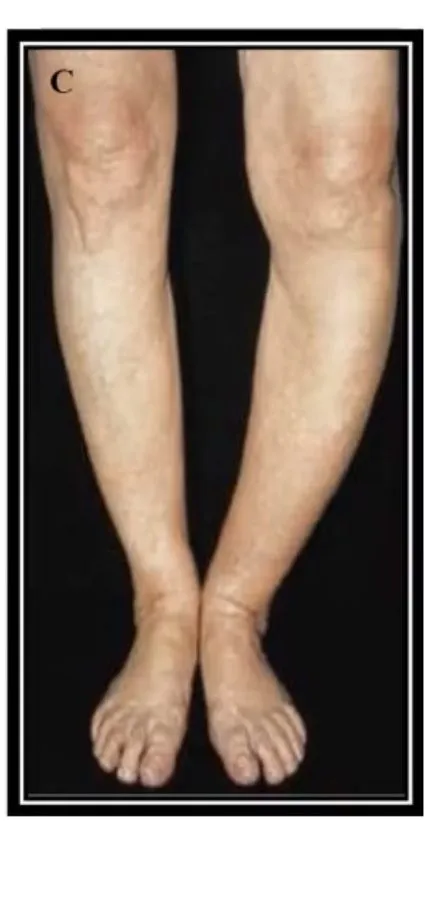 Slide 24 — genu varum