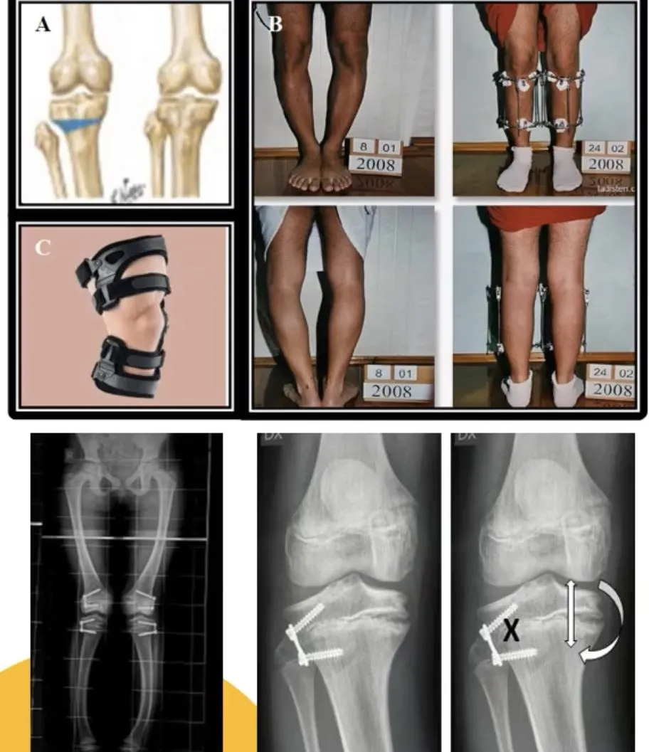 Slide 25 — proximal tibial osteotomy (A), Ilizarov frame (B), unloader brace (C), stapling X-rays