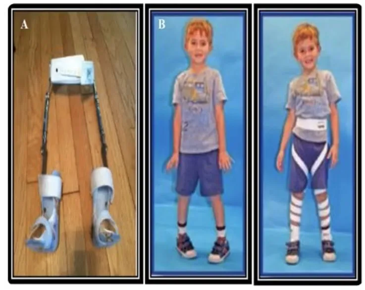 Slide 30 — night splint (A) and de-rotation straps (B)