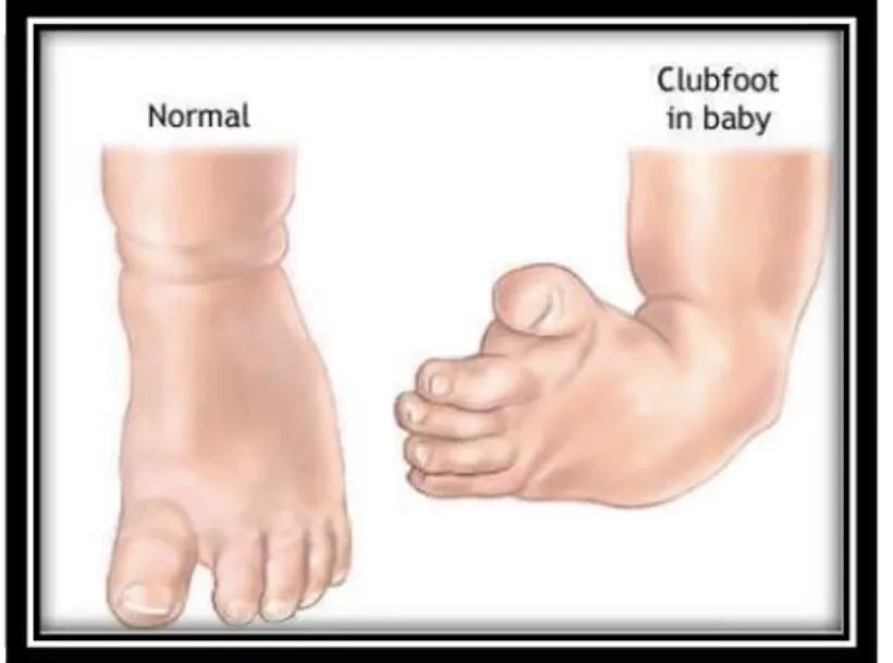Slide 31 — club foot