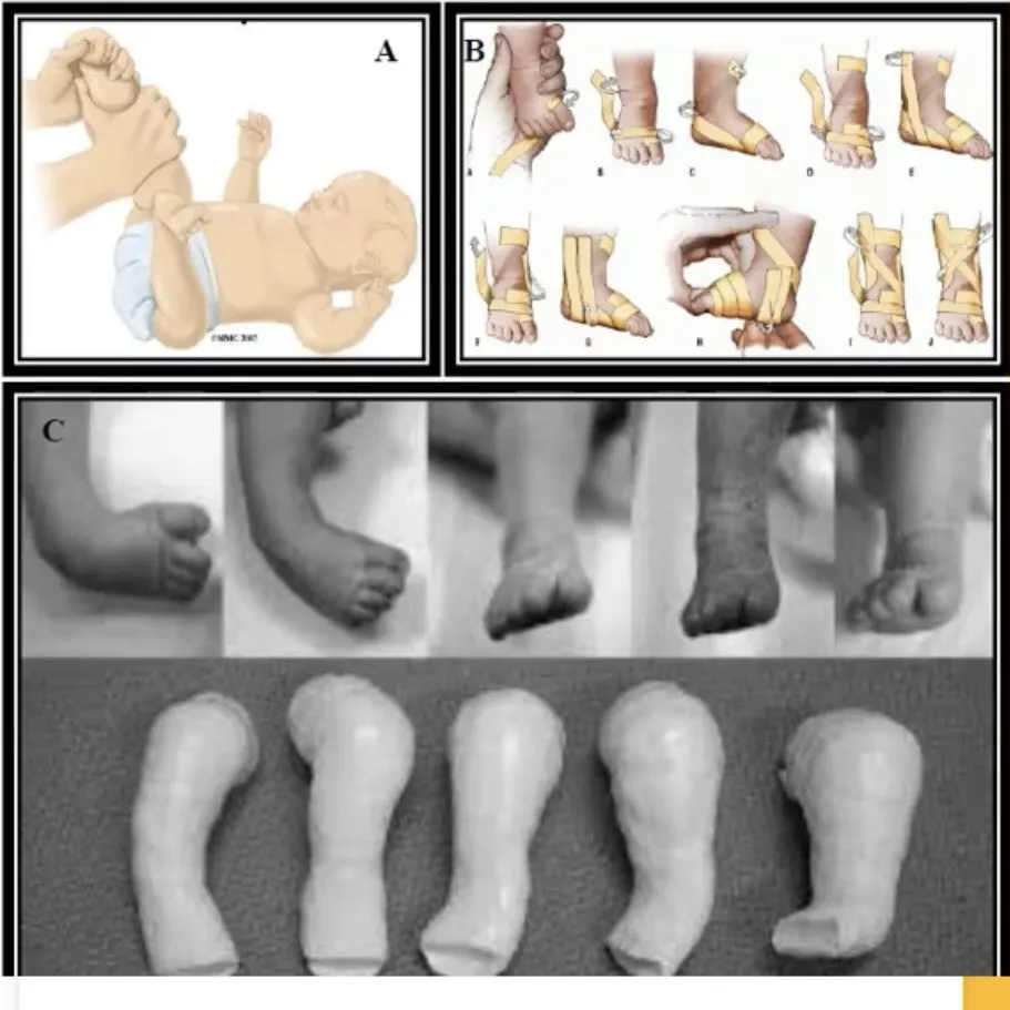 Slide 33 — manipulation (A), strapping (B), serial POP casts (C)