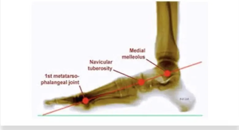 Slide 34 — Feiss line on X-ray