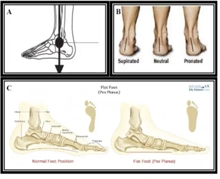 Slide 34 — pes planus