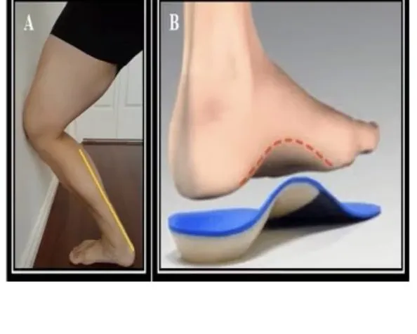 Slide 36 — heel-cord stretch (A) and arch-support insole (B)
