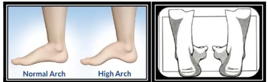 Slide 43 — pes cavus