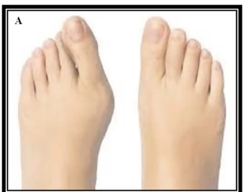 Slide 44 — hallux valgus