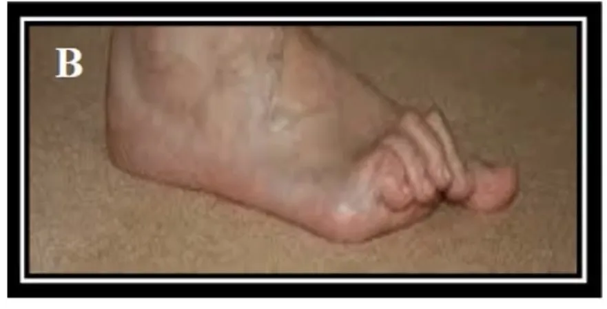 Slide 45 — claw toes