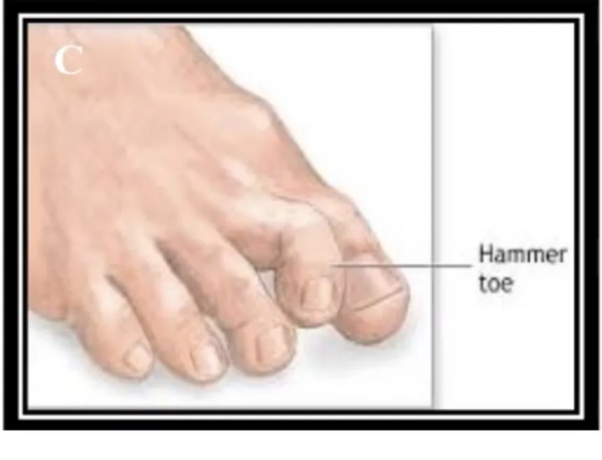 Slide 46 — hammer toe