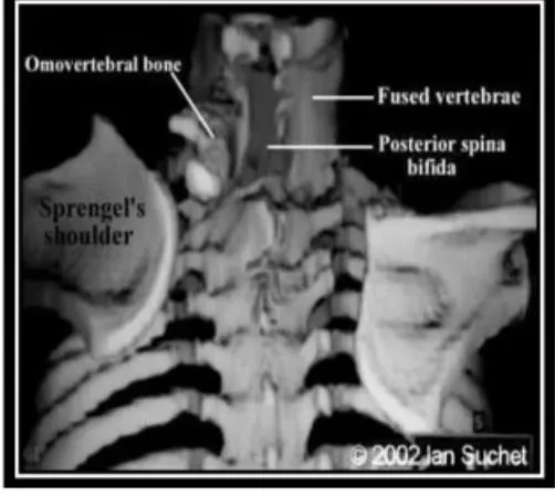 Slide 47 — Sprengel’s shoulder on CT