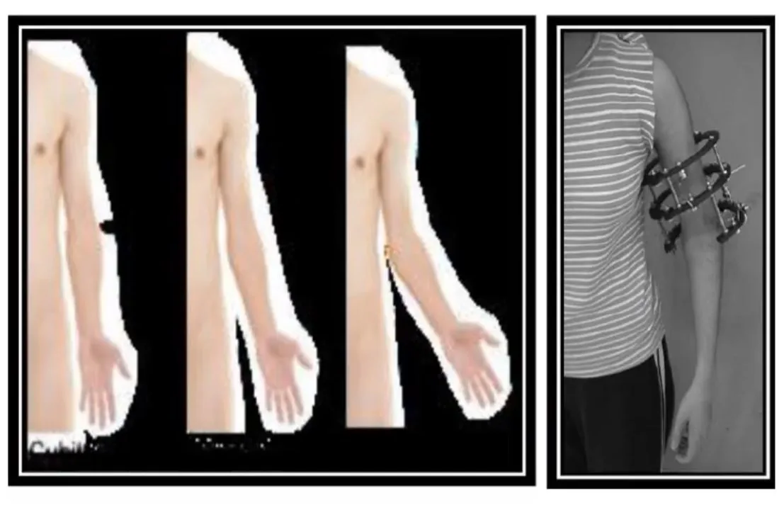 Slide 48 — cubital deformities and external fixator