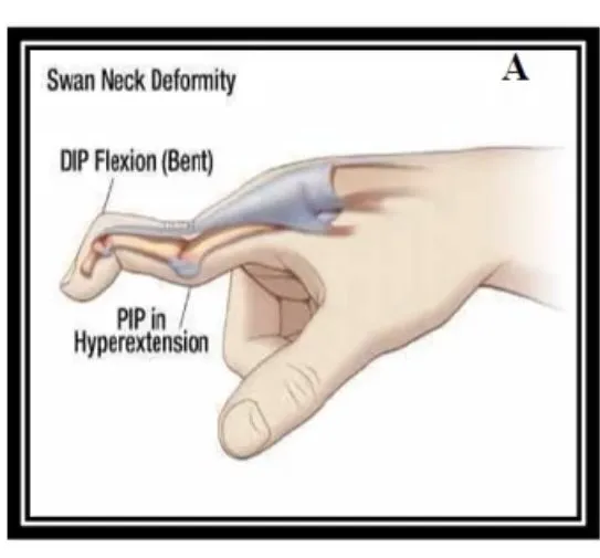 Slide 49 — swan-neck deformity