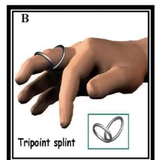 Slide 49 — tripoint (ring) splint