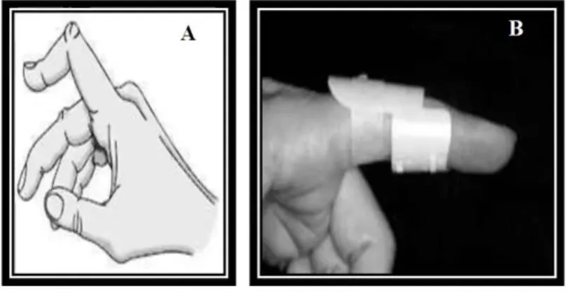 Slide 50 — boutonnière deformity and PIP splint