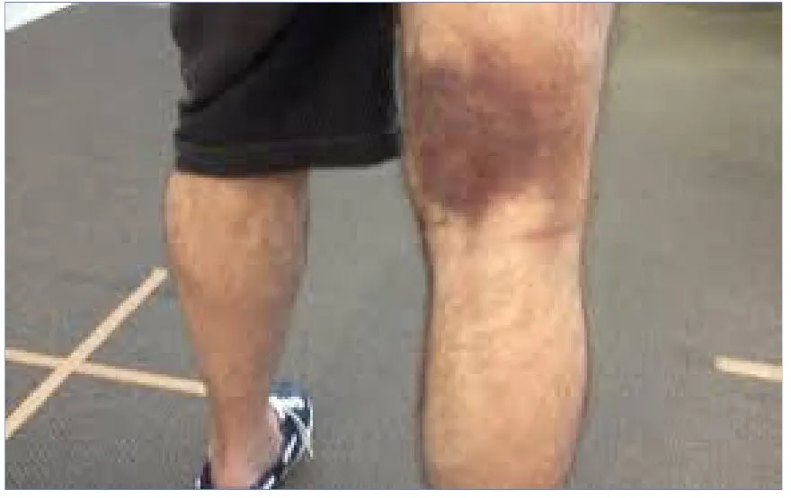 Slide 8 — acute injury: hamstring strain (bruising)