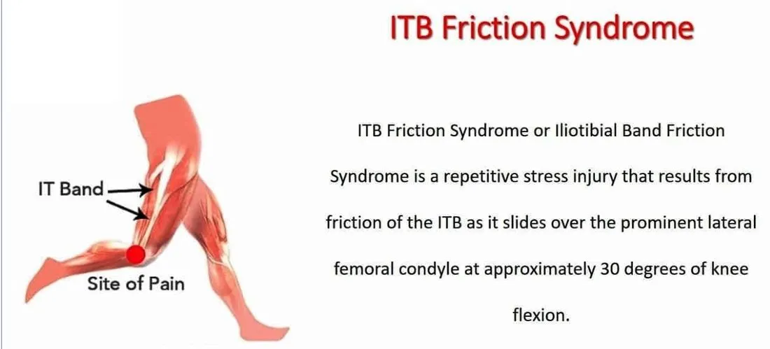 Slide 9 — ITB friction syndrome