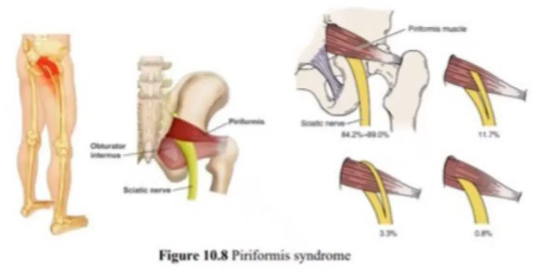 Slide 19 — piriformis syndrome (Figure 10.8)