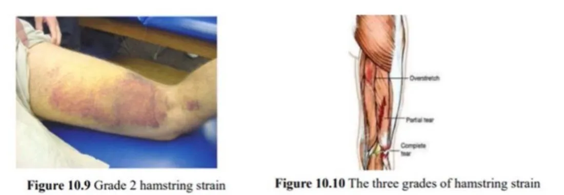 Slide 22 — grade 2 hamstring strain (Figure 10.9) and the three grades of strain (Figure 10.10)