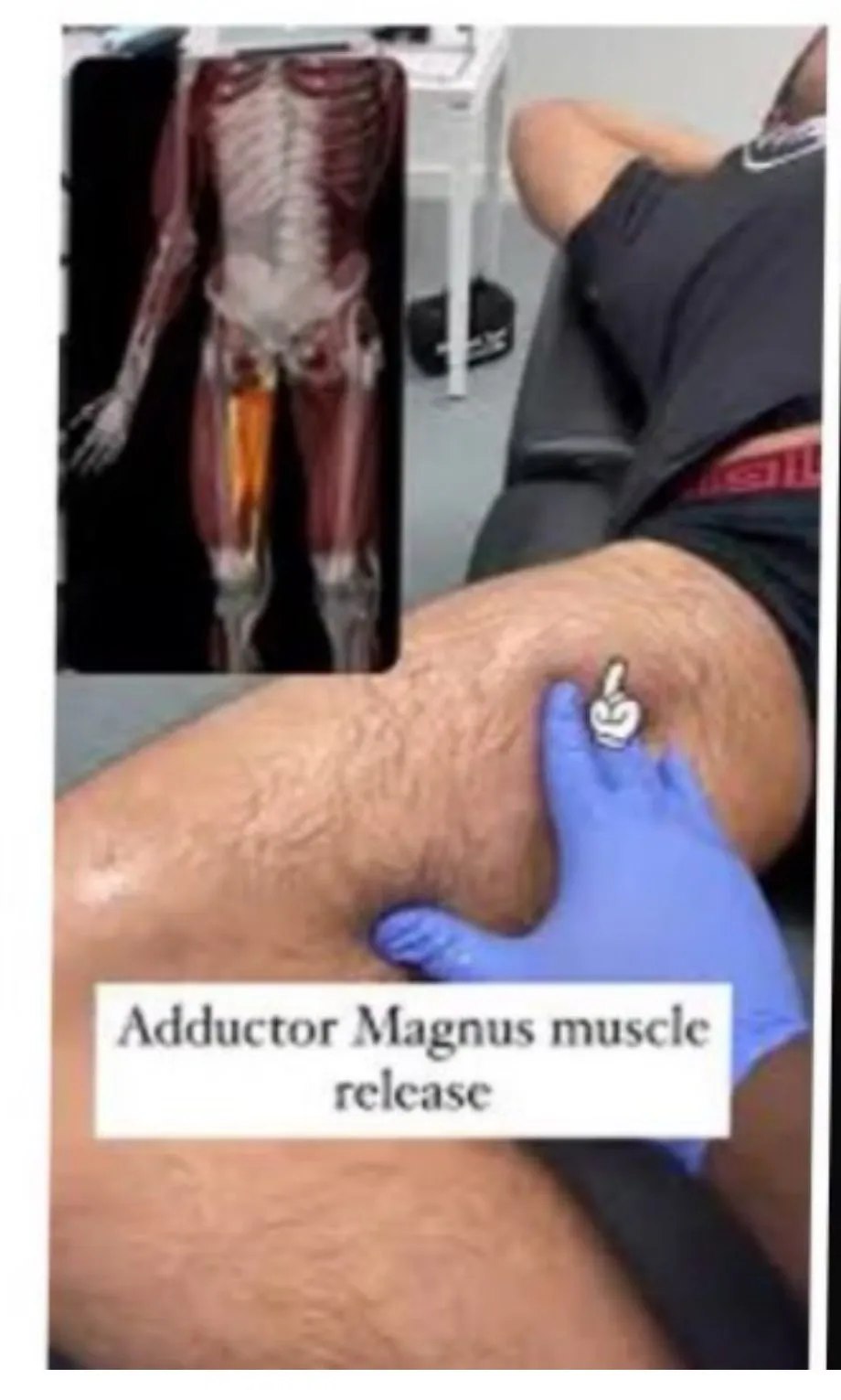 Slide 51 — adductor magnus muscle release