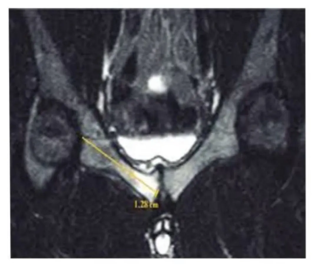 Slide 53 — T2 MRI of the pelvis