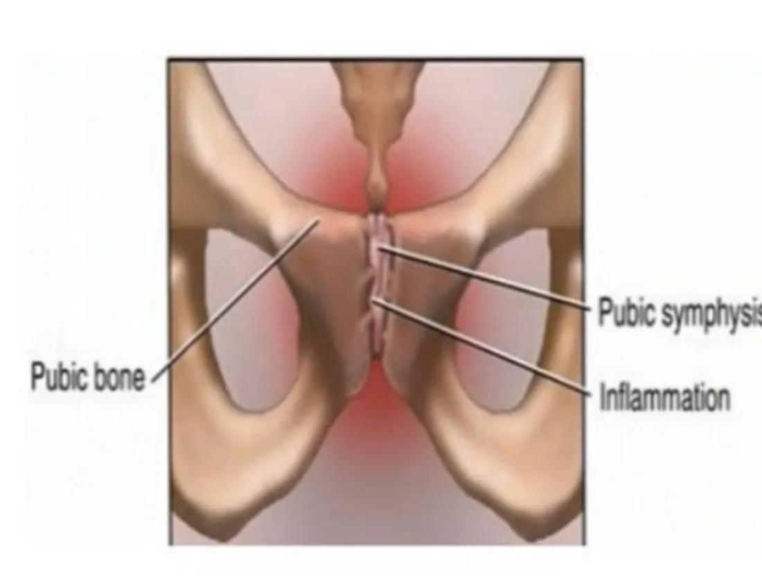 Slide 53 — pubic symphysis with inflammation
