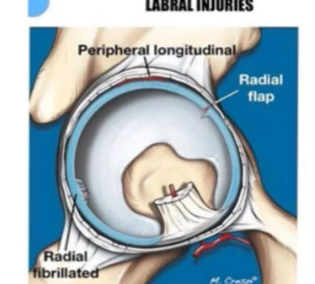 Slide 57 — labral injuries: peripheral longitudinal, radial flap, radial fibrillated