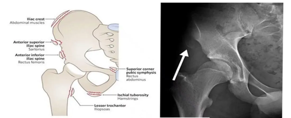Slide 65 — avulsion sites on the pelvis, and an X-ray with an avulsion (white arrow)