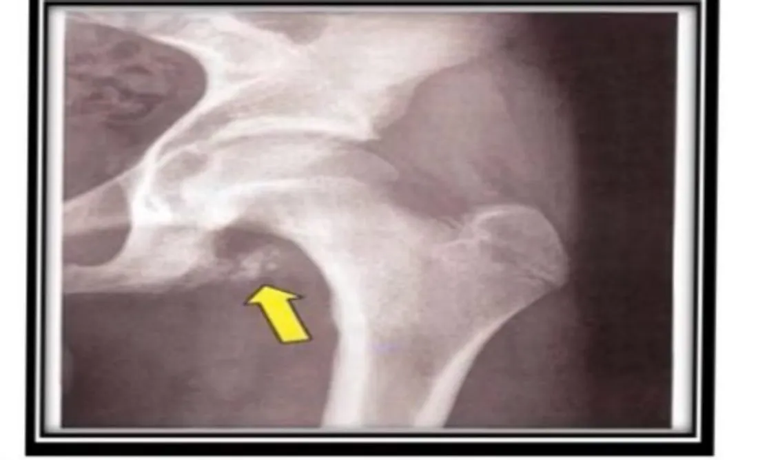 Slide 66 — X-ray of an ischial tuberosity avulsion (yellow arrow)