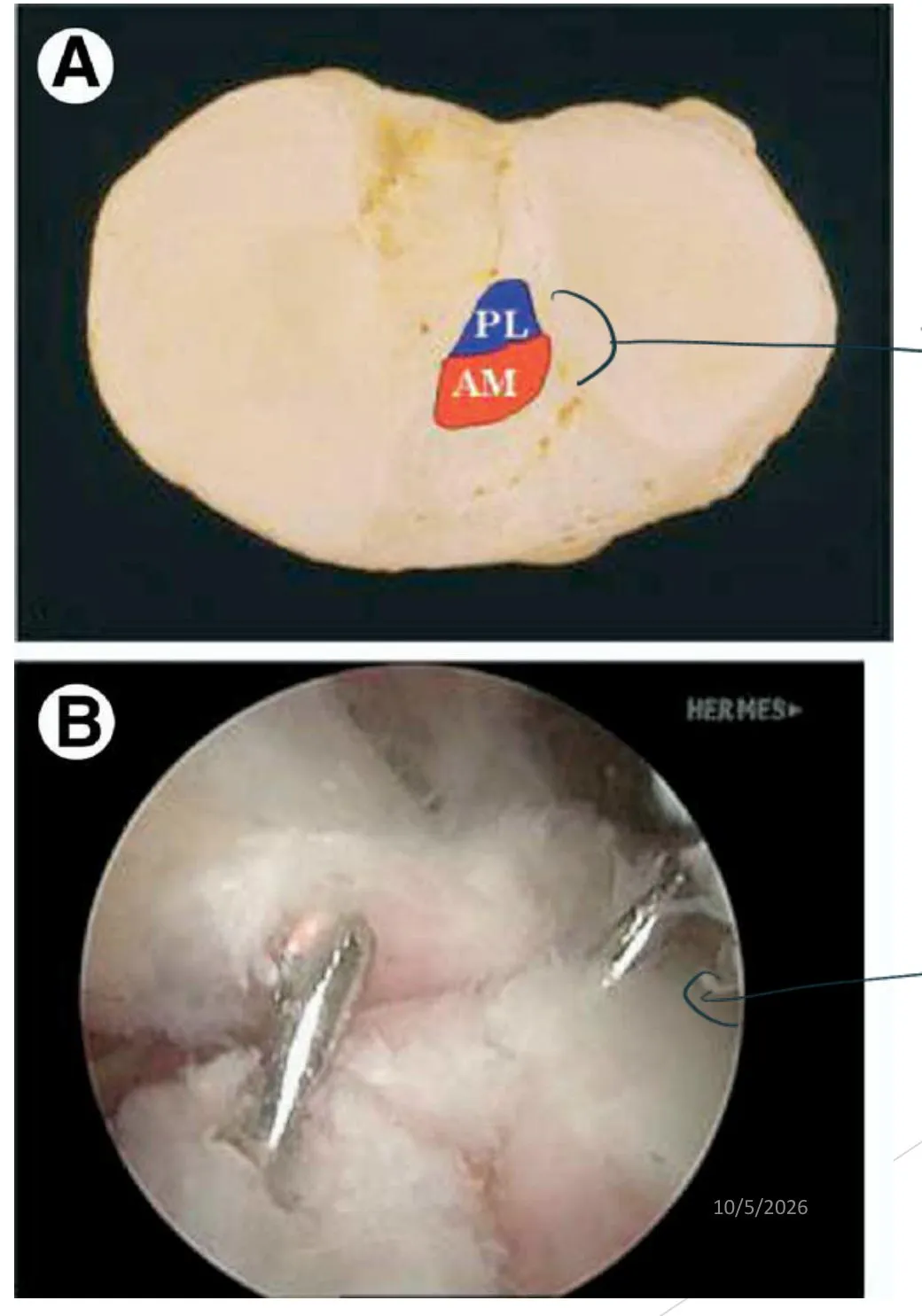 Slide 10 — (A) tibial section with the PL and AM bundles labelled, (B) arthroscopic view