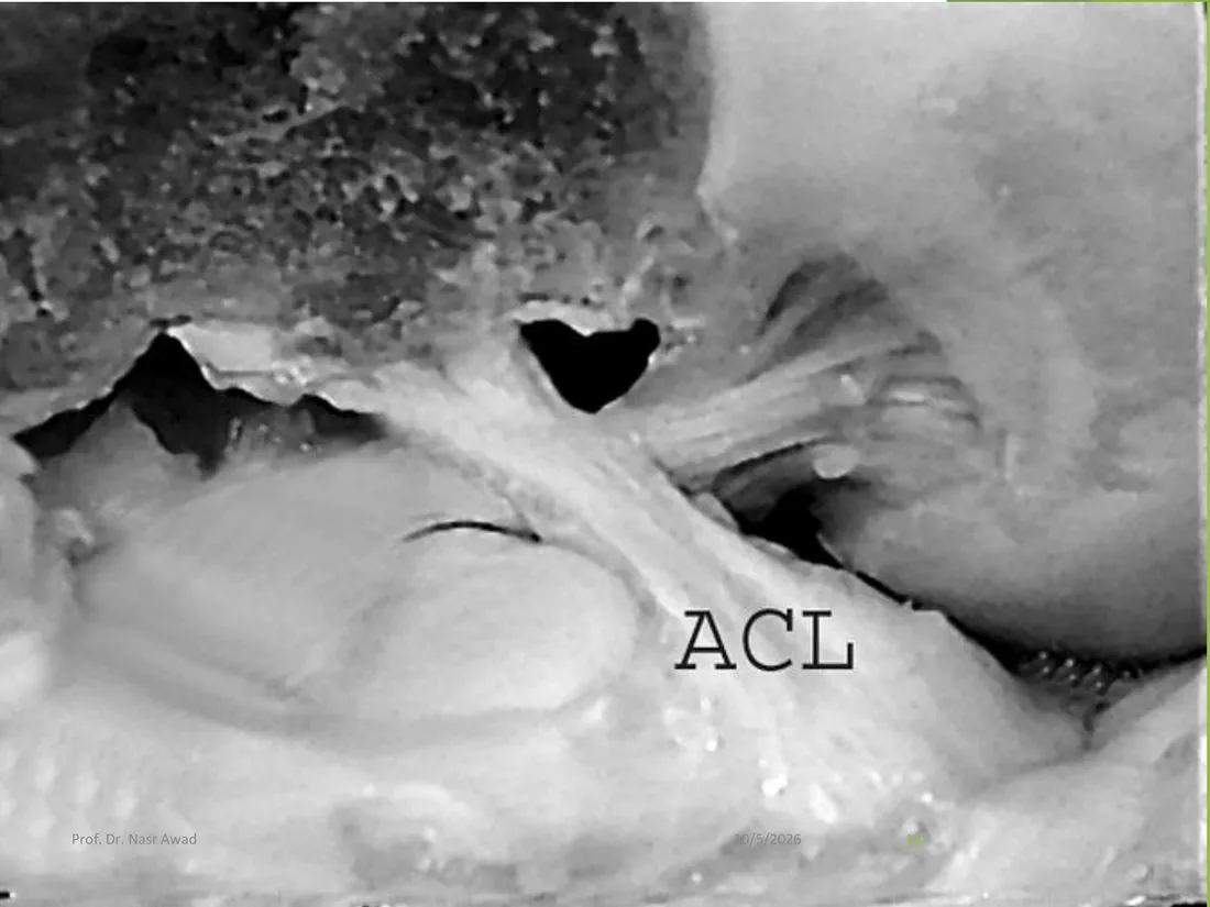 Slide 12 — cadaver photo labelled ACL