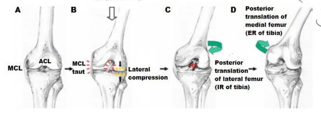 Slide 27 — proposed non-contact ACL injury mechanism (A–D)