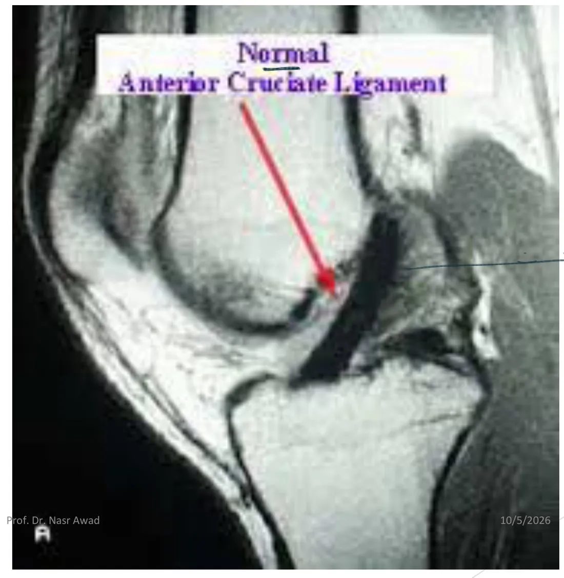Slide 51 — normal anterior cruciate ligament on MRI