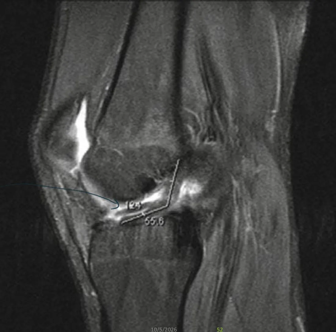 Slide 52 — primary sign: abrupt angulation