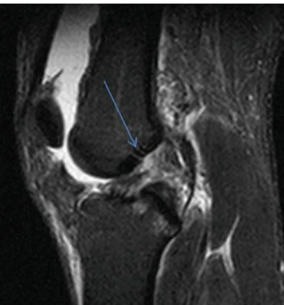 Slide 53 — primary sign: rupture with increased signal (blue arrow)