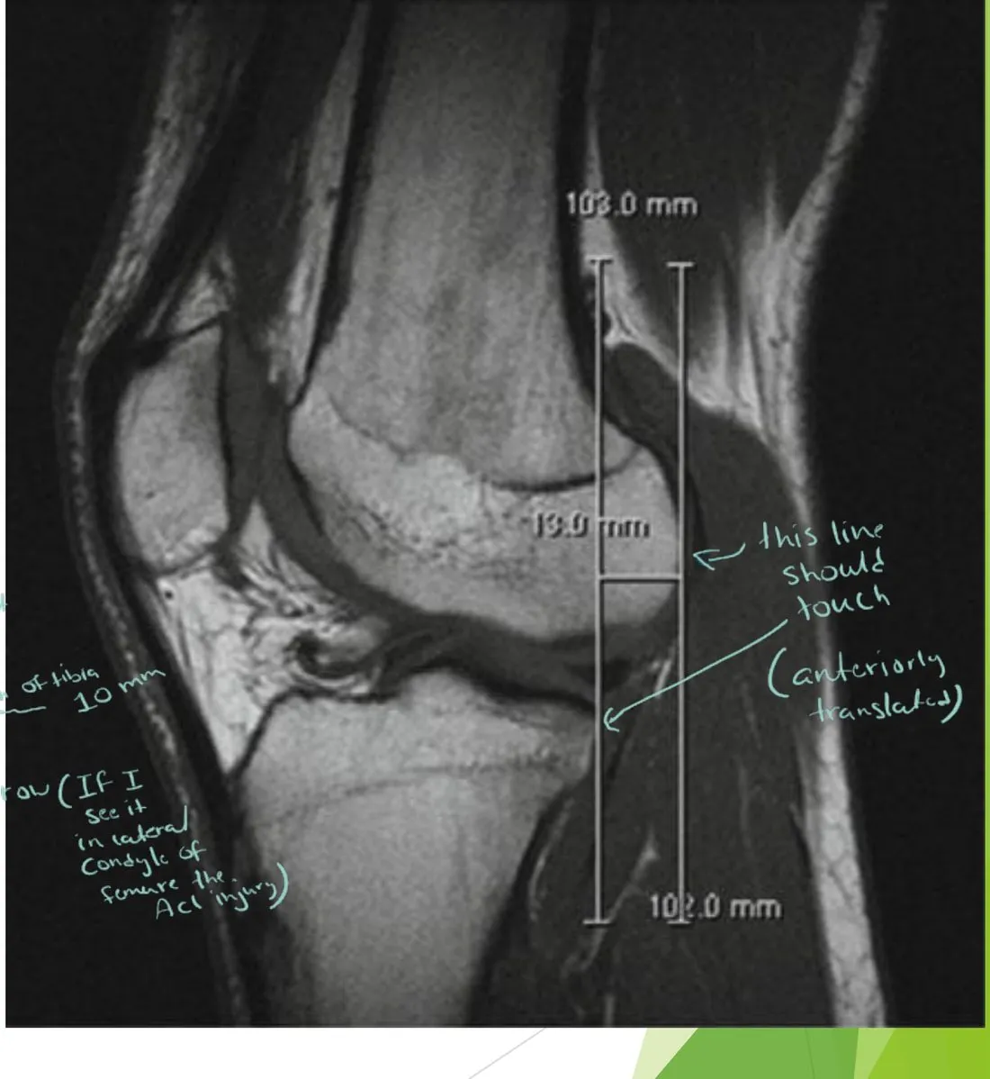 Slide 54 — secondary sign: anterior translocation of the tibia (10 mm)