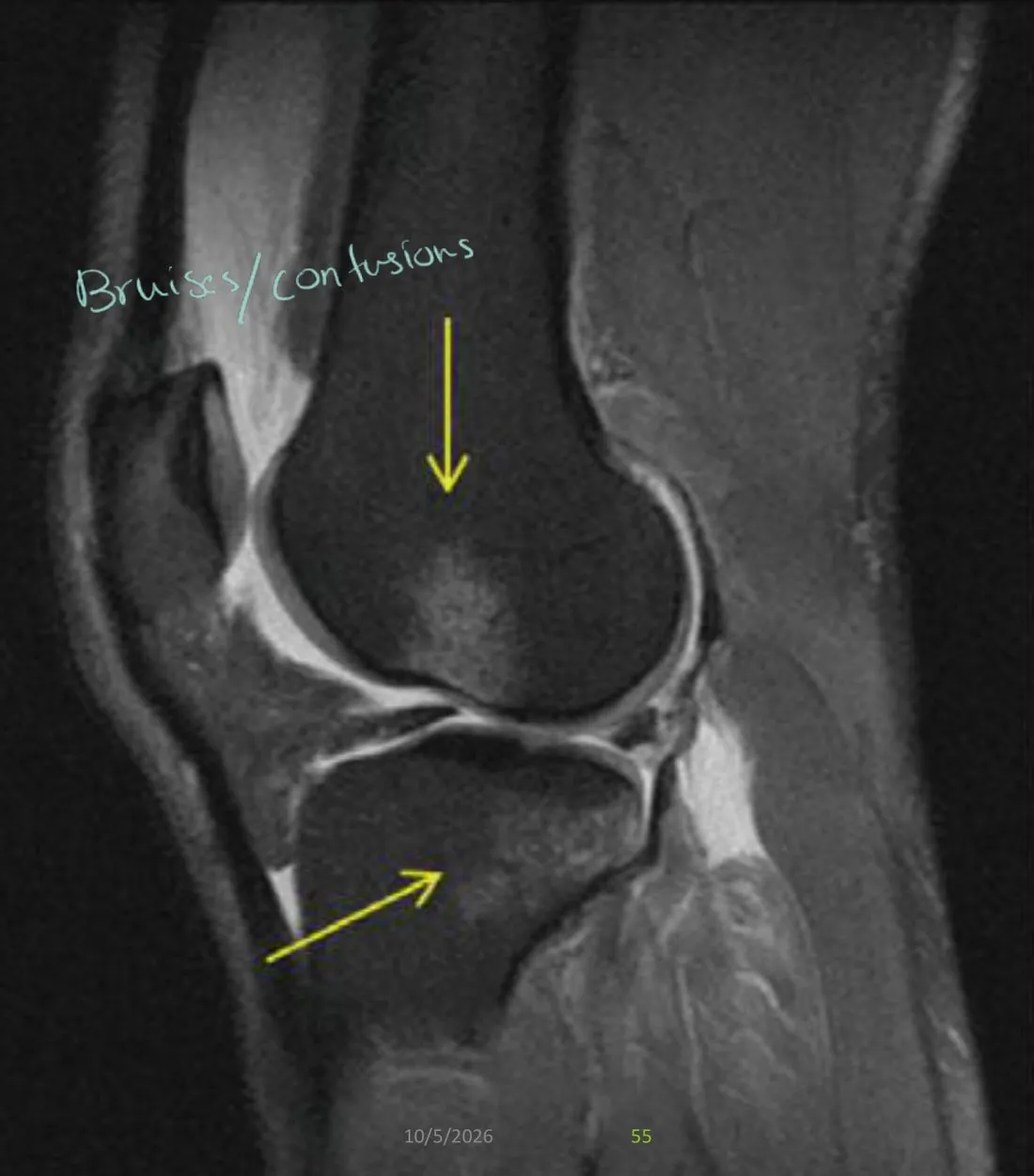 Slide 55 — secondary sign: femoral and tibial bruises