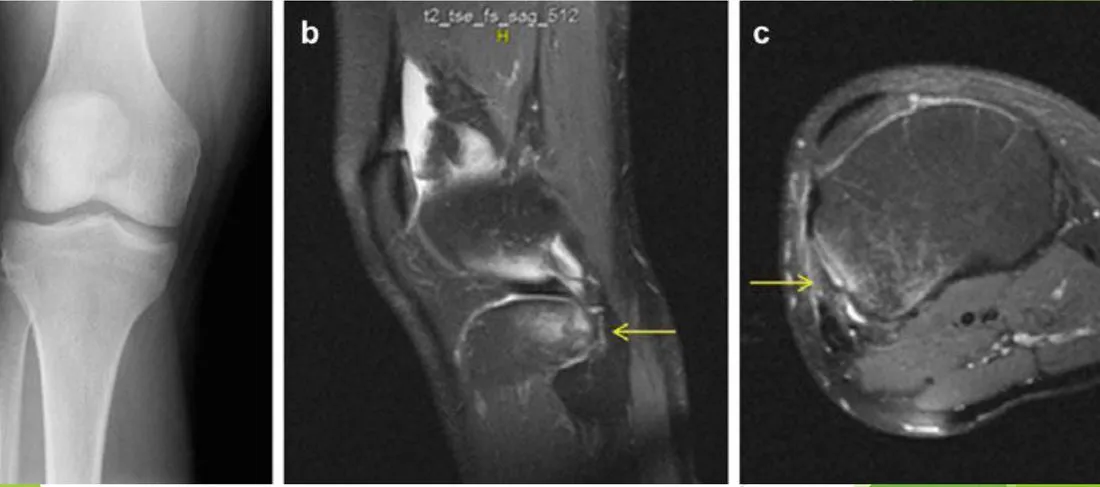 Slide 56 — Segond fracture: radiograph (a), T2 sagittal MRI (b), axial MRI (c)