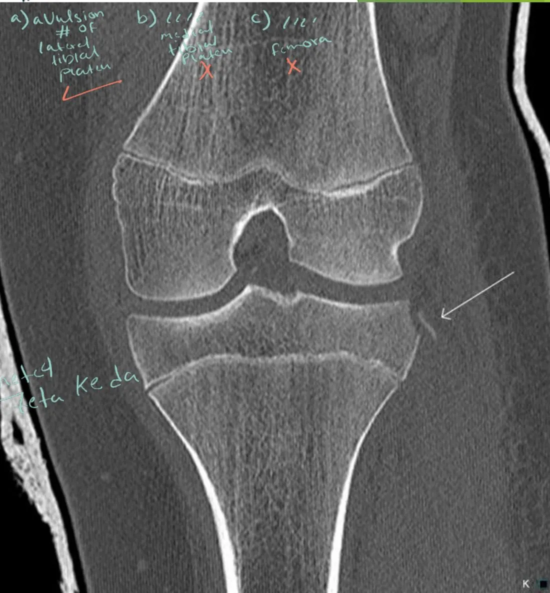 Slide 57 — image beside the 2017 MRI study of Segond fractures