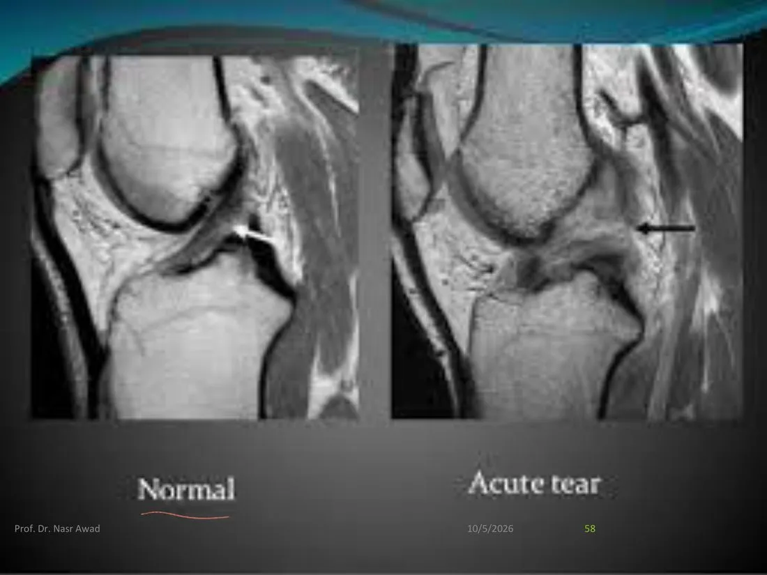 Slide 58 — normal vs acute tear (same picture as slide 64)
