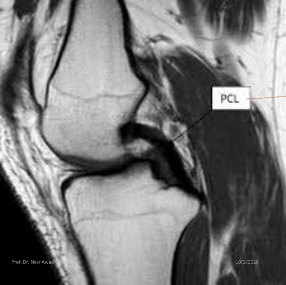 Slide 59 — MRI labelled PCL