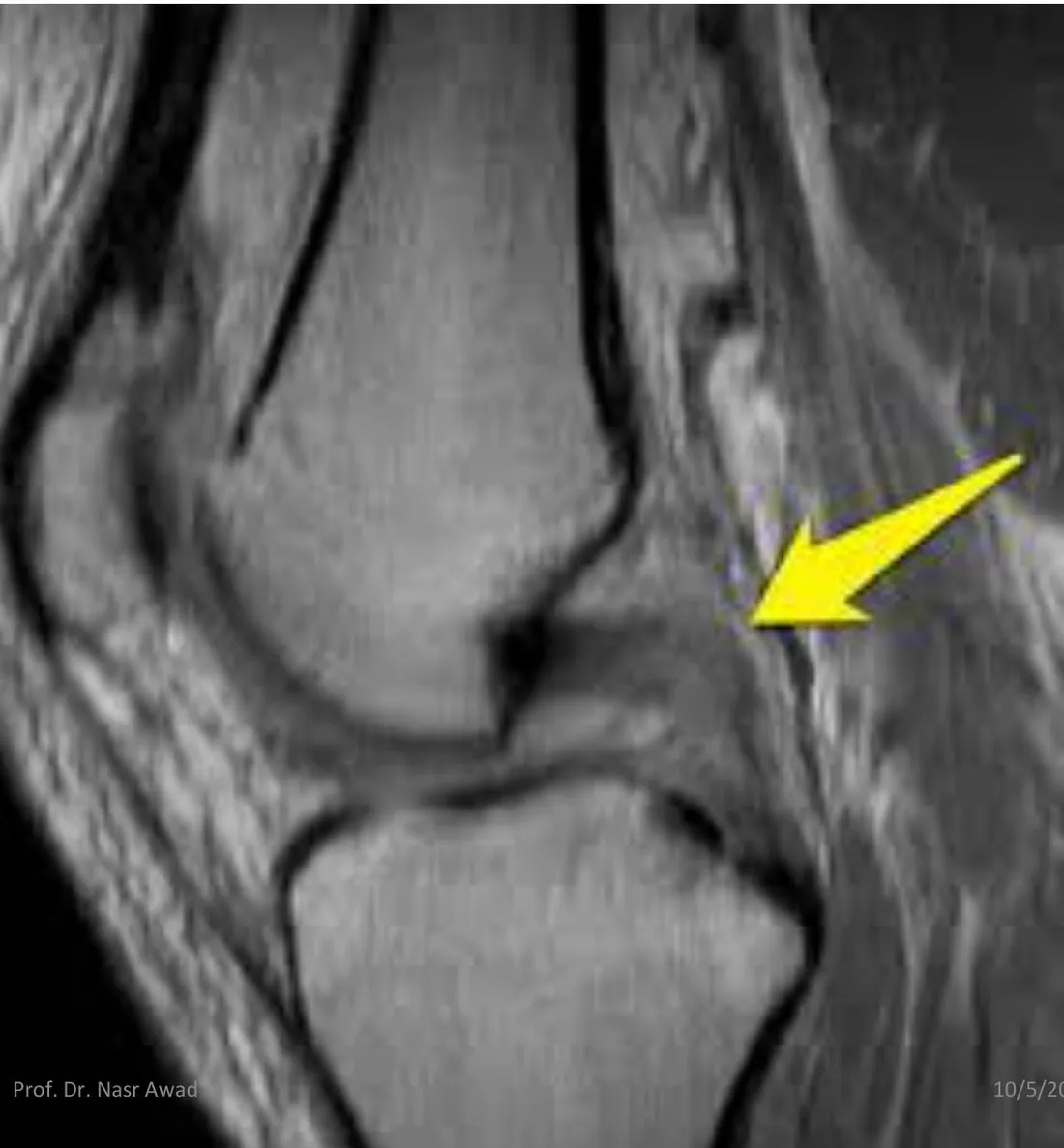 Slide 60 — MRI with yellow arrow